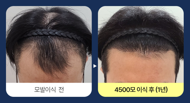비절개모발이식 1년 전후 사진